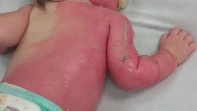 baby-burned-hose_1465666697987.jpg