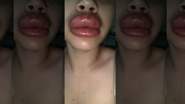 Valley women claim botched lip injections caused severe infection