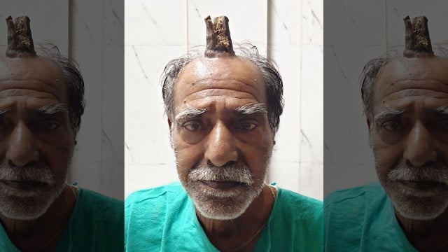 Man has 4-inch 'devil horn' removed from head