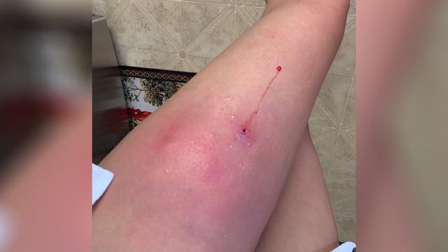 ‘Started spreading up my leg': Woman gets flesh-eating bacteria after swimming at beach