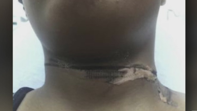 Doctors warn consumers about generic phone chargers after woman's neck injury