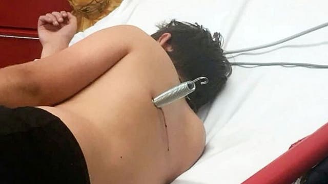 Boy, 12, survives 'freak' trampoline accident after metal spring shot into his back 'like a bullet'