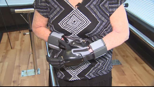 Quadruple amputee receives new bionic hands
