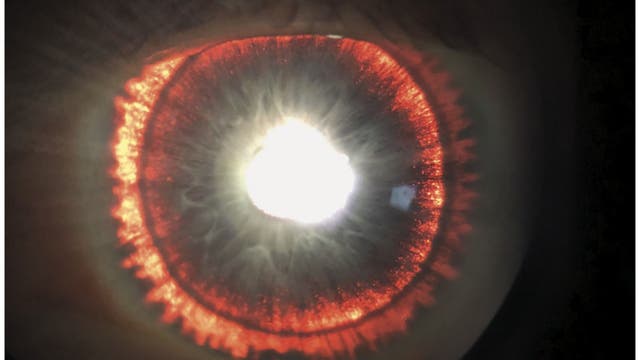 Rare syndrome causes man’s eye to 'glow'