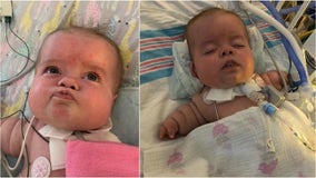 Prayers needed for Georgia baby with rare form of dwarfism