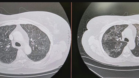 COVID-19 long haulers share experiences of inhalers, hazy lung X-rays