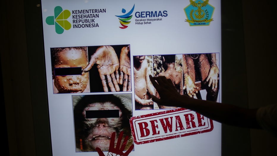 Monkeypox virus detection in Indonesia