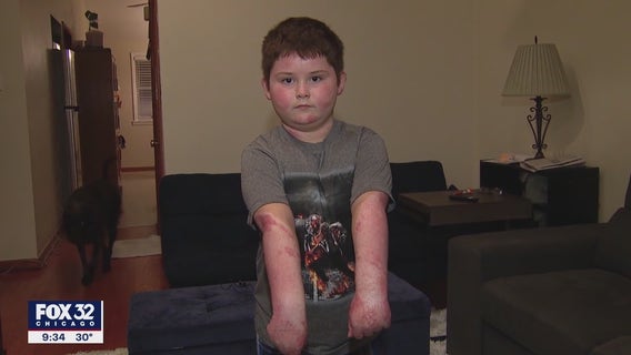 Chicago boy who suffered third-degree burns in fire that killed his grandmother still recovering