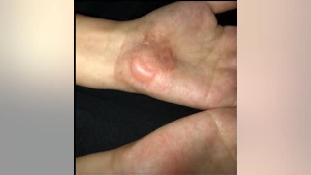 Children burned in Channelview PE class allegedly by teacher's form of discipline