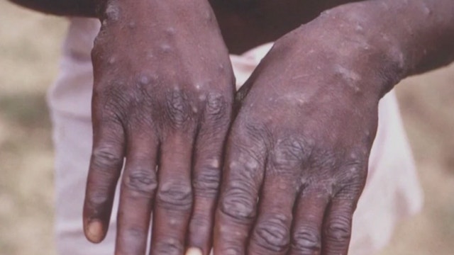 Second probable case of monkeypox reported in Illinois