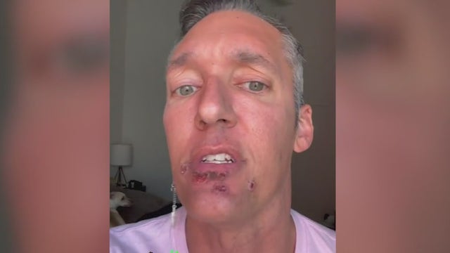 Man suffering with monkeypox speaks out as cases rise in Chicago area