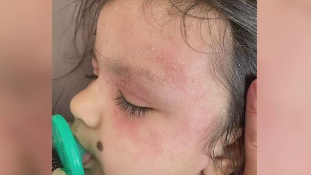 New eczema treatment approved for younger patients