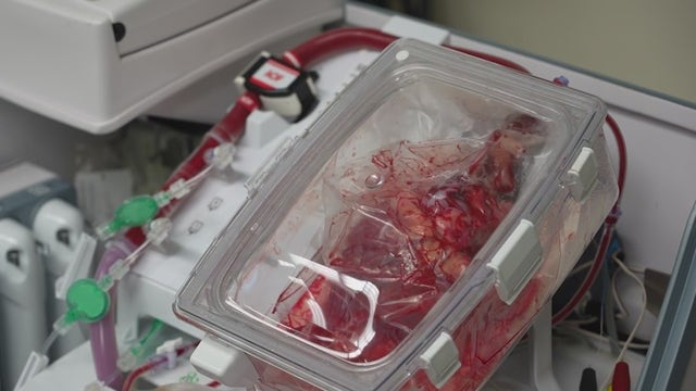Northwestern heart surgeons successfully transplant heart from donor whose heart stopped beating