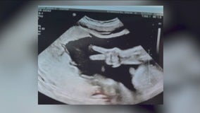 Hammond couple's baby gives 'peace sign' during ultrasound