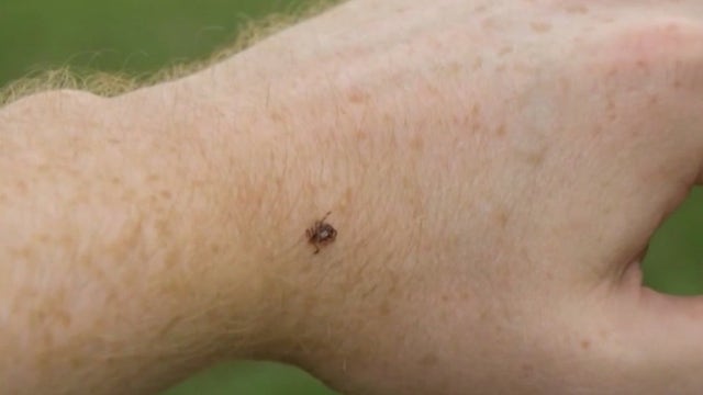 Cases of Lyme disease on the rise in the Midwest as the weather warms up