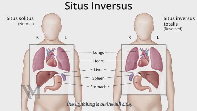 Northwestern Medicine successfully performs double-lung transplant on patients with 'flipped organs'