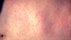 Measles in Chicago: 2 new cases reported, totaling 15