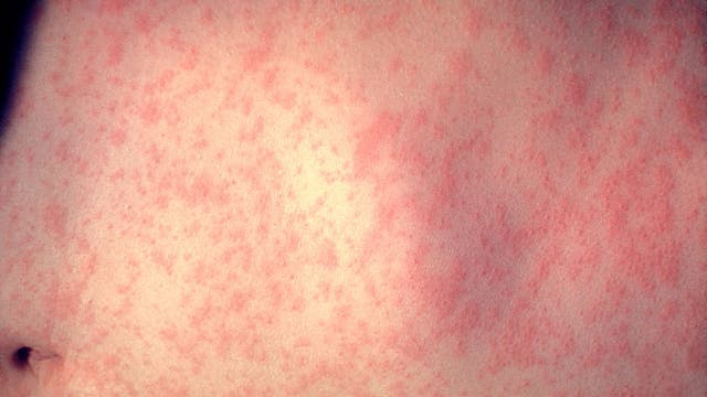 Measles in Cook County: Two cases confirmed, here's what we know