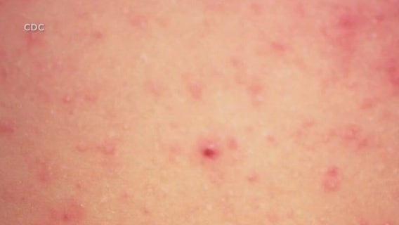 Will County confirms case of measles
