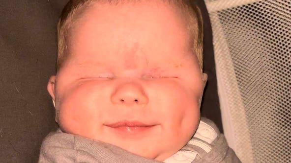 Baby born without eyes, diagnosed with rare genetic disorder