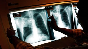 'Small number' of tuberculosis cases confirmed in Chicago migrant shelters