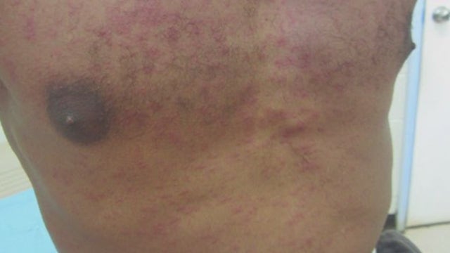 Measles exposure alert issued by Cook County Health following confirmed cases in Chicago
