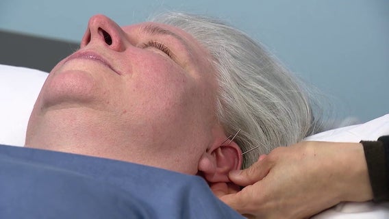 Spring allergy sufferers turn to needle treatment for natural relief