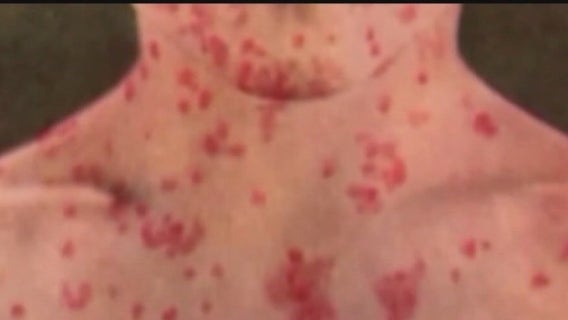 Health officials prepare to welcome potentially 2K migrants per week this summer amid measles outbreak