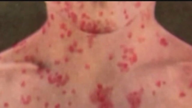 Health officials prepare to welcome potentially 2K migrants per week this summer amid measles outbreak