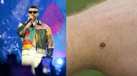 Justin Timberlake has Lyme disease — Here’s why it’s commonly misdiagnosed, according to an expert