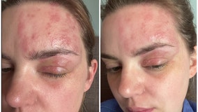 FOX 32 reporter shares painful shingles journey to warn others at risk: 'Stopped me in my tracks'