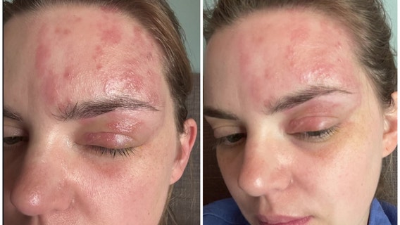 FOX 32 reporter shares painful shingles journey to warn others at risk: 'Stopped me in my tracks'