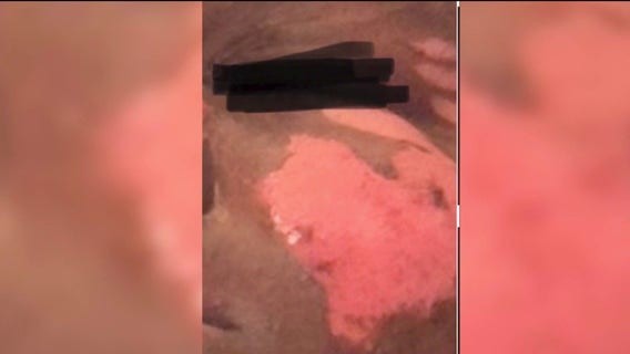 Chicago-area doctors warn TikTok challenge is sending teens to the hospital