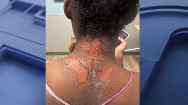 Mom says teen suffered severe burns in school bullying attack: 'She’s in a lot of pain'