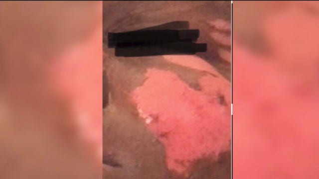 Chicago-area doctors warn TikTok challenge is sending teens to the hospital