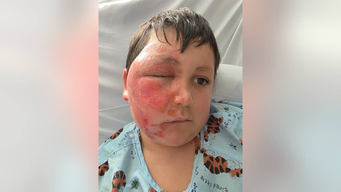 Suburban Chicago boy burned after NeeDoh toy explodes in microwave