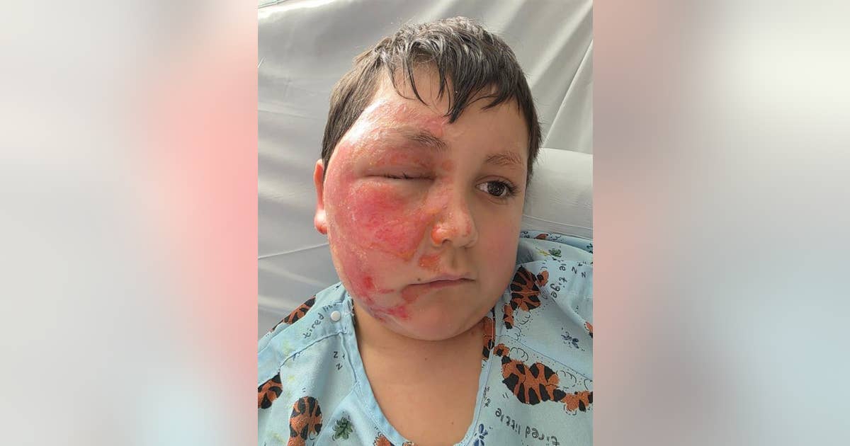 Needoh Exploded Suburban Chicago boy burned after NeeDoh toy explodes in microwave ...