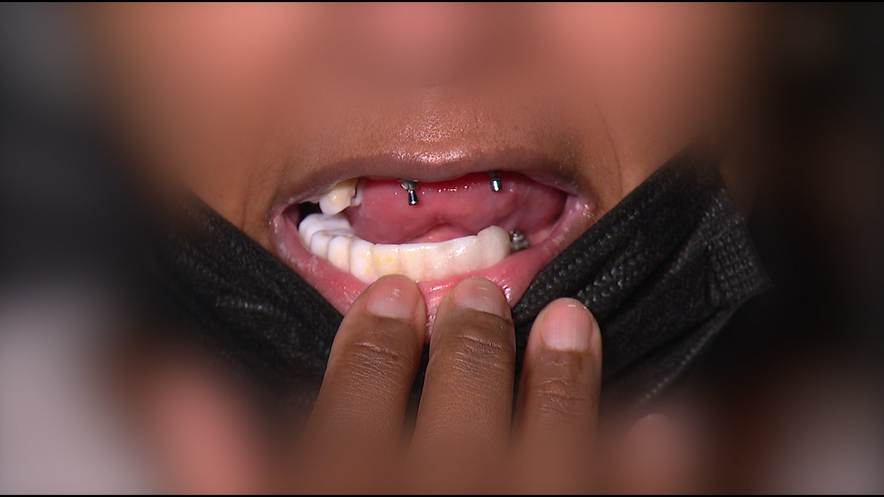 Chicago-area dentist accused of leaving patients without permanent teeth: 'I used Gorilla Glue'