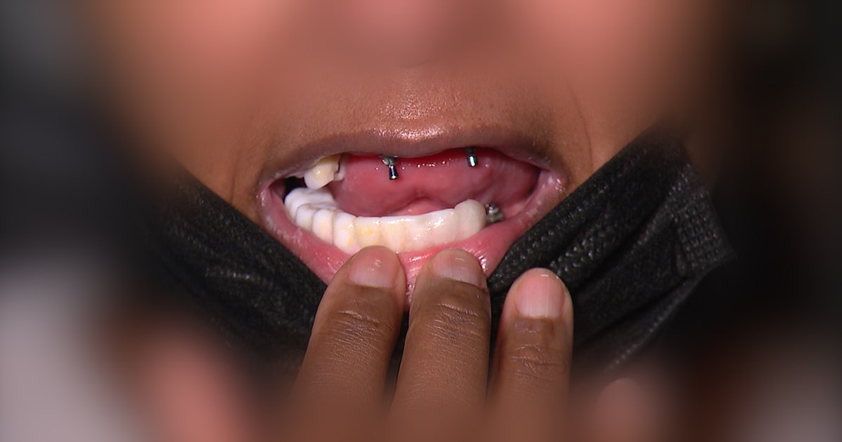 Chicago-area dentist accused of leaving patients without permanent teeth: 'I used Gorilla Glue'