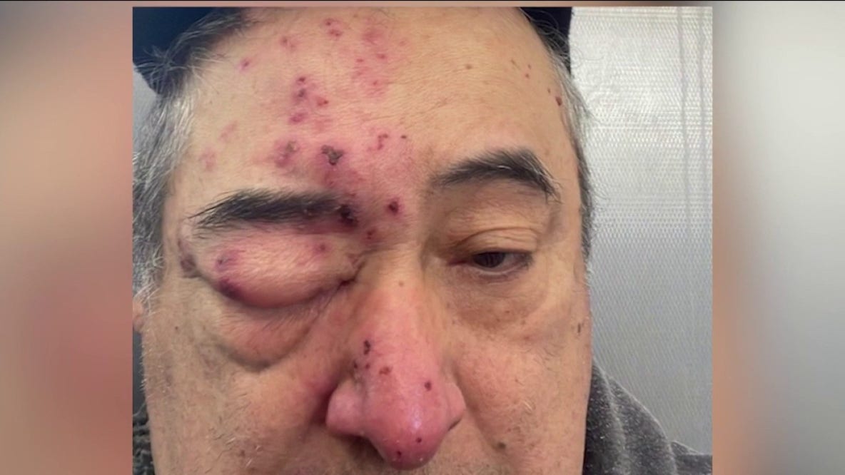 'I felt them on my face': Rogers Park tenant says rats chewed on him while he slept