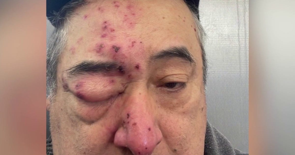 'I felt them on my face': Rogers Park tenant says rats chewed on him while he slept