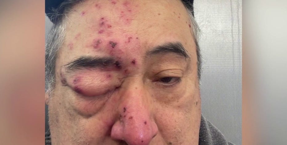 'I felt them on my face': Rogers Park tenant says rats chewed on him while he slept
