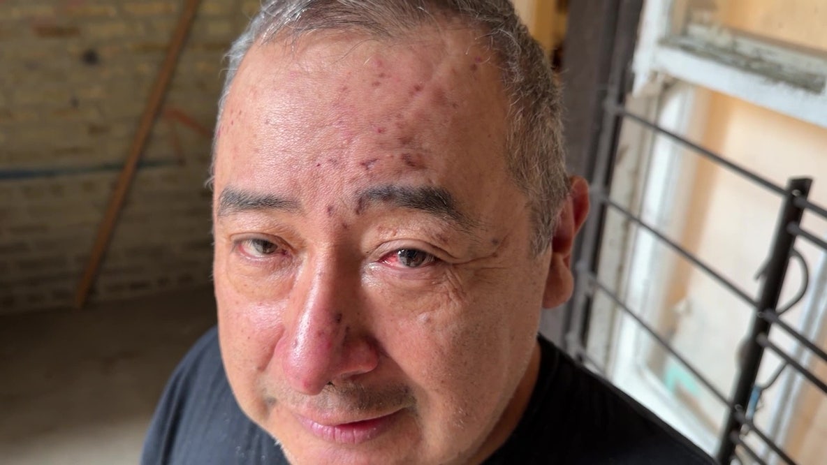 Viral Chicago rat attack story leads to eye-saving diagnosis