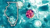 Illinois cyclosporiasis cases surge as doctors warn about certain produce