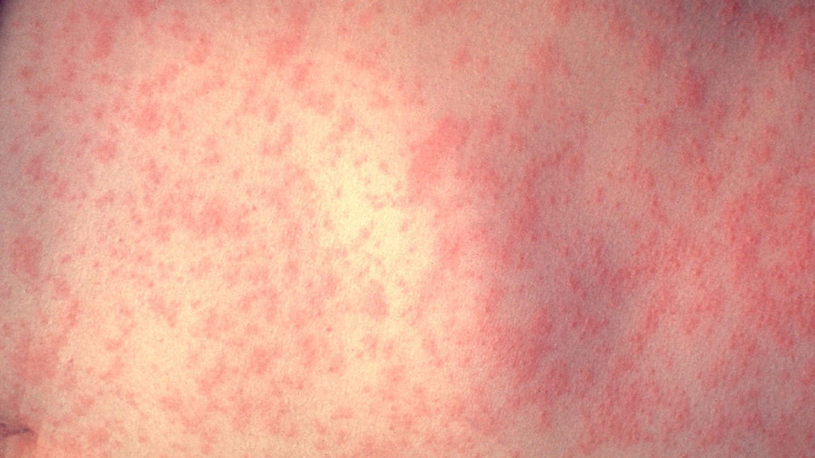 Illinois measles case, deaths in Pennsylvania prompt vaccination warning