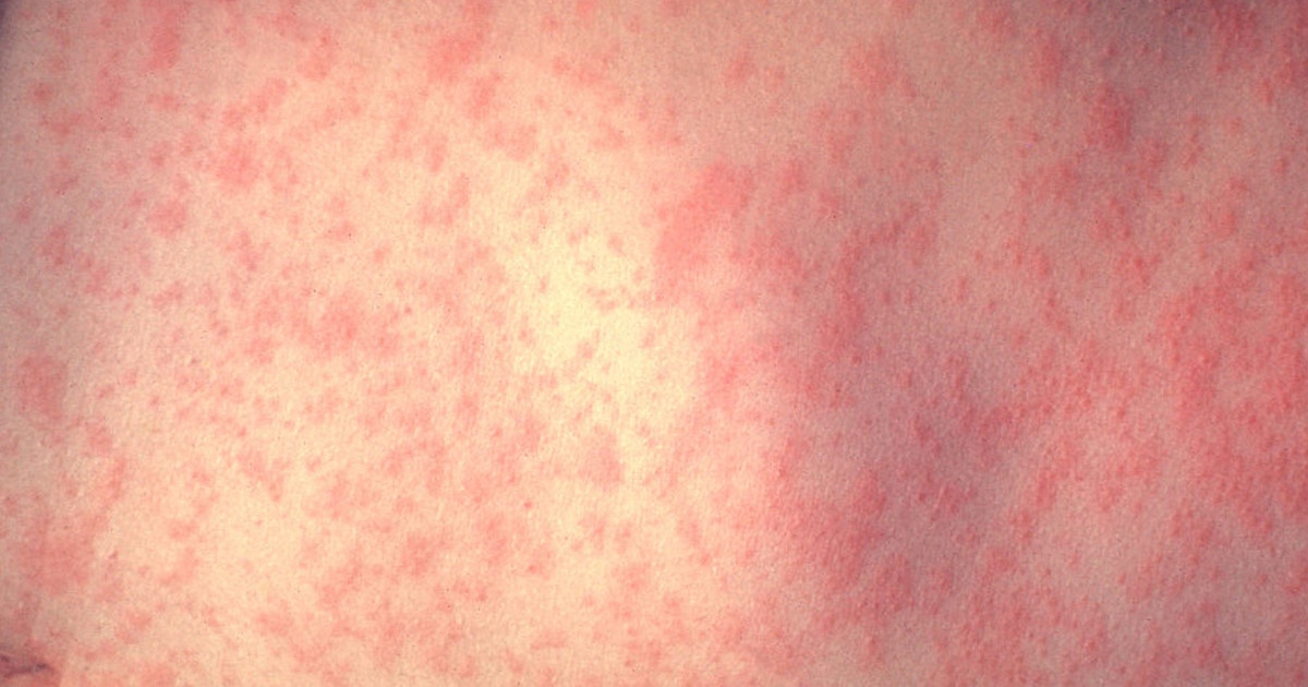 DuPage County confirms first measles case of 2026