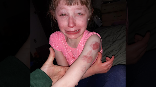 Girl with special needs bitten by student on school bus