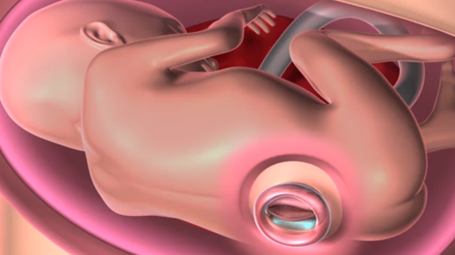 Cleveland Clinic performs its first in utero surgery on fetus, repairs spina bifida before birth