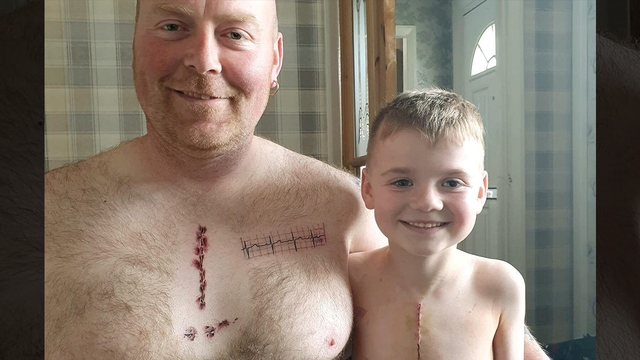 Dad's tattoo matches son's life-saving heart surgery scar