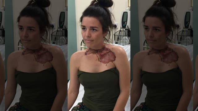 Woman says 'sore throat' led to near-fatal infection that left her with hole in neck